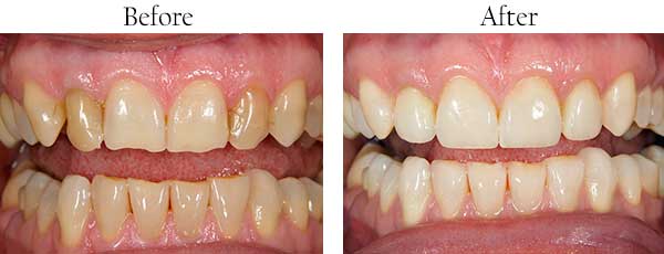 Croton Falls Before and After Invisalign