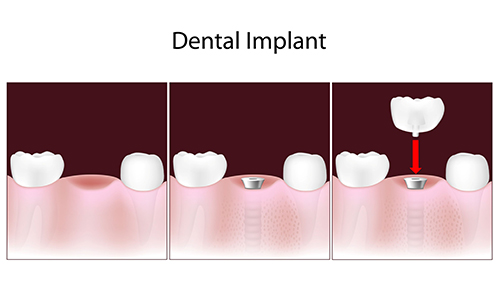 Dental Implants in Croton Falls