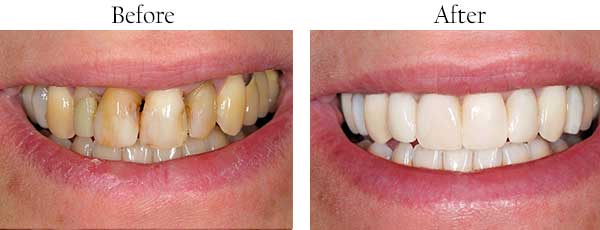 Croton Falls Before and After Teeth Whitening