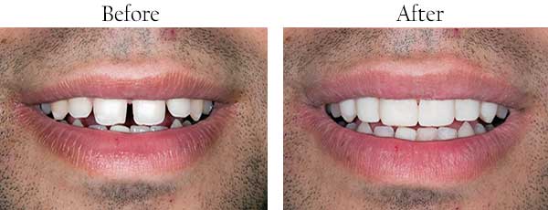 Croton Falls Before and After Smile Makeover